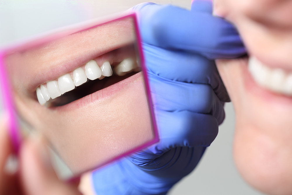 奥歯を失った時の治療方法
